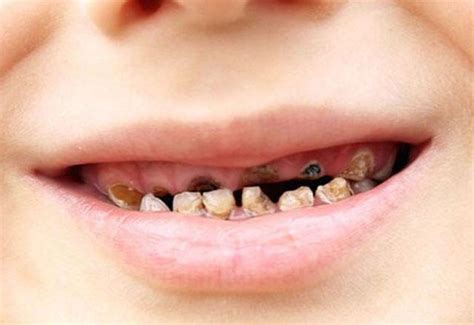 Bebeklerde diş siyahlaşması neden olur